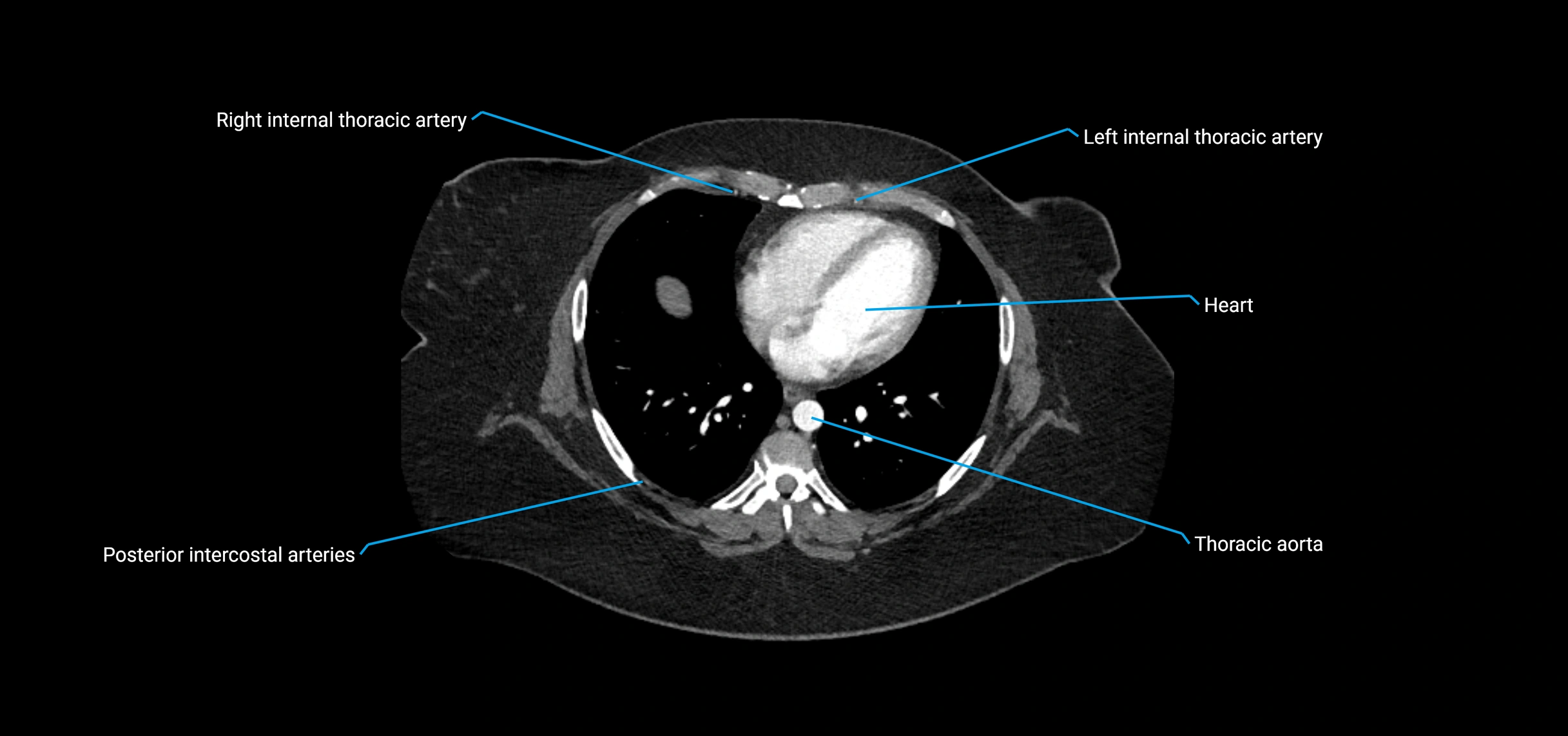 CTA abdomen axial cross sectional anatomy labelled image_2 (2).webp